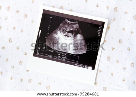 Photo of an ultrasound sonogram of an unborn baby