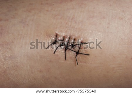 Close-up picture of a skin wound with stitches