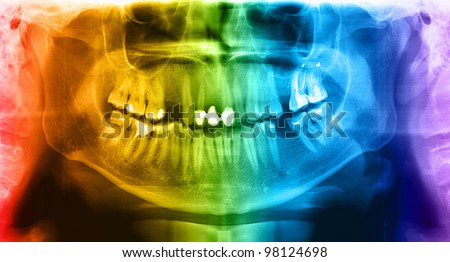 X-ray teeth mandible human skull. Panoramic negative photo facial image of mouth young adult male. Picture was taken on digital system equipment for dental diagnostic examination upon clinical checkup