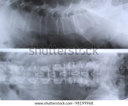 Roentgen shot of spine segment