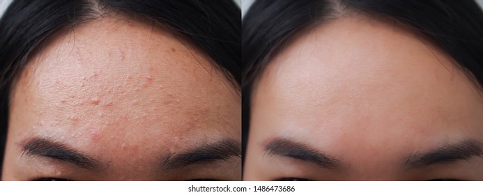 Image Before And After Acne Pimple Treatment On The Face Of Young Asian Woman. Problem Skincare And Beauty Concept. 