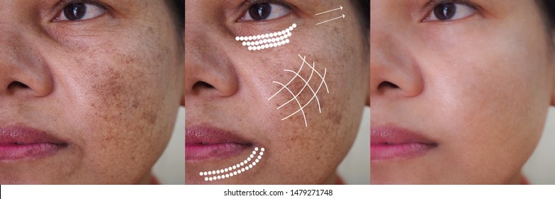 Image Before And After Anti - Aging Dark Spot Melasma Pigmentation Skin Facial Treatment And Face Lift Rejuvenation Of Asian Woman. Problem Skincare And Health Concept. 