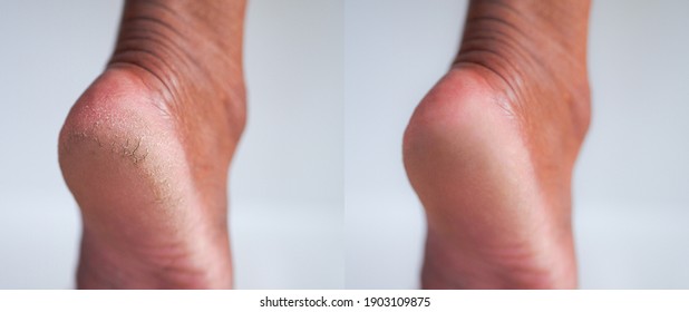 Image Before And After Cracked Heel Skin Of Foot Treatment Concept. 