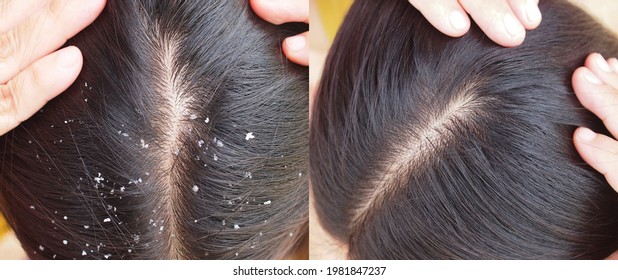 Image Before And After Dandruff Treatment Shampoo On Hair Woman. Problem Health Care Concept. 