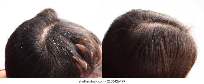 Image Before And After Dandruff Treatment Shampoo On Hair Woman. Problem Health Care Concept.