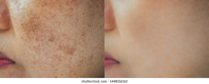  Image Before And After Dark Spot Melasma Pigmentation Skin On Face Asian Woman. Problem Skincare And Health Concept. 