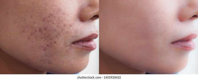 Image Before And After Dark Spot Scar Acne And Melasma Pigmentation Skin Facial Treatment On Face Asian Woman. Problem Skincare And Beauty Concept. 