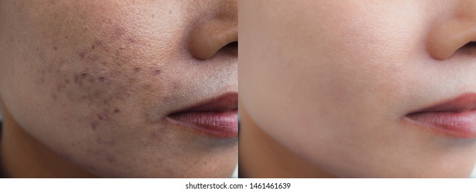 Image before and after dark spot scar acne and melasma pigmentation skin facial treatment on face asian woman. Problem skincare and health concept. 