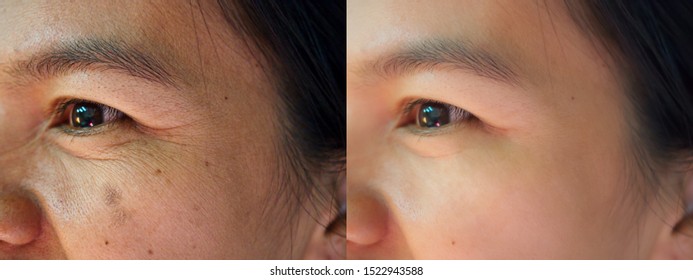 Image before and after dark spot melasma pigmentation skin facial treatment on face asian woman. Problem skincare and health concept. 