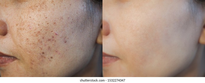 Image Before And After Dark Spot Scar Acne And Melasma Pigmentation Skin Facial Treatment On Face Asian Woman. Problem Skincare And Health Concept. 