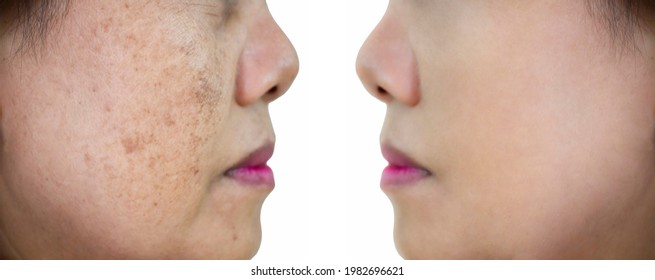 Aging Spots Before After Hd Stock Images Shutterstock