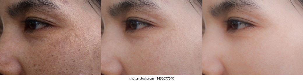 Image before and after facial treatment problem of skin scar acne dark spot melasma pigmentation on the face of Asian woman compare in 3 periods. Beauty and health care concept. 