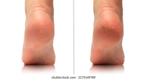 Image before and after feet dry skin cracked heel treatment. Cracked heels before and after treatment and treatment. Medical pedicure in a beauty salon. Problematic dehydrated feet with dry skin.