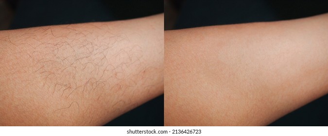 Image Before And After Leg Hairs Removal Concept.