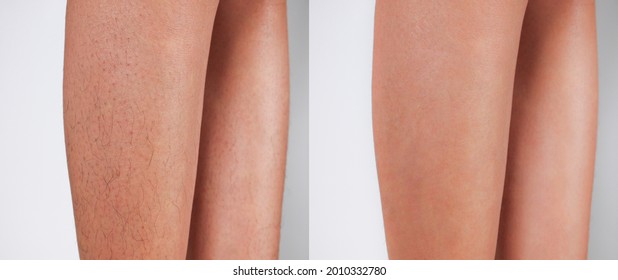 Image before and after Legs hairs removal concept. 