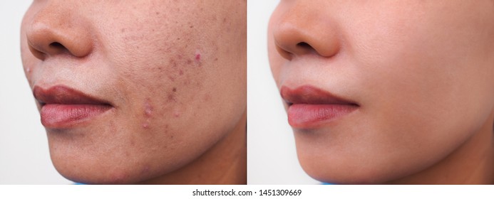 Aging Spots Before After Hd Stock Images Shutterstock