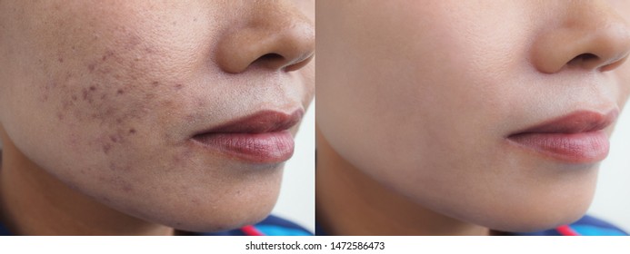 Image Before And After Scar Acne And Dark Spots Melasma Pigmentation Skin Facial Treatment On Face Asian Woman. Problem Skincare And Beauty Concept. 