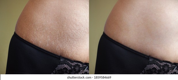 Image before and after skin stretch marks removal treatment.  - Shutterstock ID 1859584669