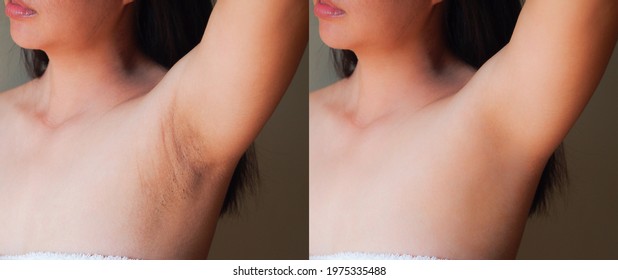 Image before and after skincare cosmetology armpits epilation treatment concept.Problem underarm chicken skin,Fox Fordyce,Black armpit in woman.