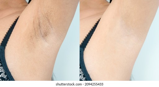 Image Before And After Skincare Cosmetology Armpits Epilation Treatment Concept. Close Up Underarm Skin Problem Rough Chicken Skin, Fox Fordyce, Black Armpit In Asian Woman.