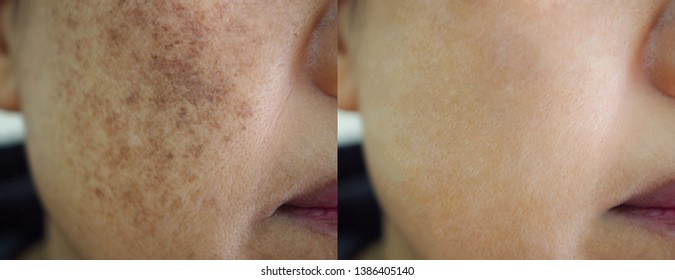 Image before and after spot melasma pigmentation facial treatment on face asian woman. Problem skincare and health concept.  - Shutterstock ID 1386405140