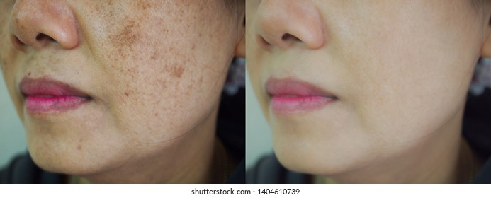 Image before and after spot melasma pigmentation facial treatment on face asian woman. Problem skincare and health concept. 