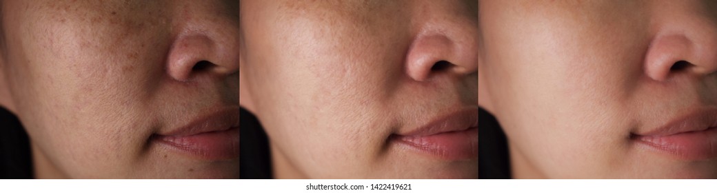 Imágenes Fotos De Stock Y Vectores Sobre Red Mark Skin - asian roblox face