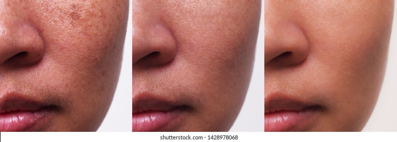Image before and after spot melasma pigmentation treatment on skin face asian woman compare in 3 weeks. Problem Skincare and health concept. 