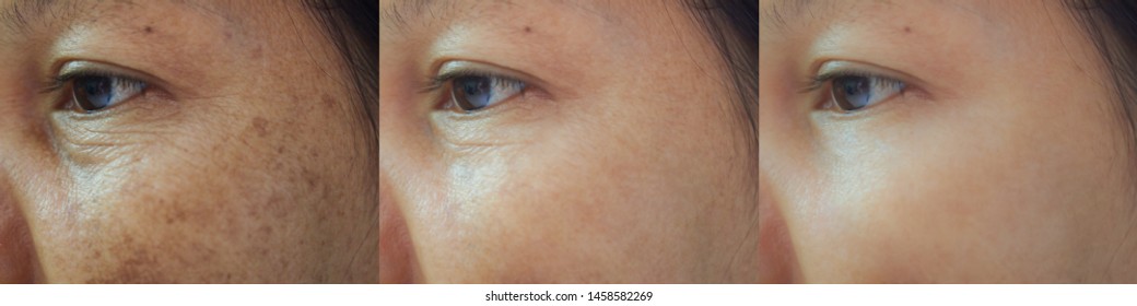 Image before and after spot melasma pigmentation treatment on skin face asian woman compare in 3 periods. Skincare and beauty concept