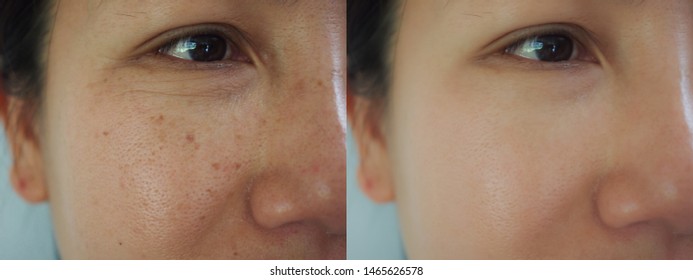 Aging Spots Before After Hd Stock Images Shutterstock