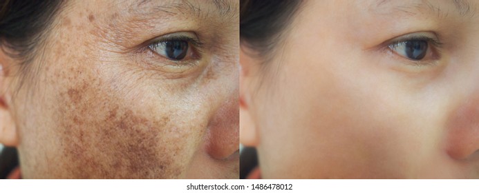 Skin Whitening Treatment Before And After - your magazine lite