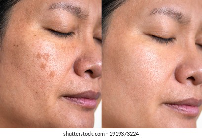 Image before and after spot melasma pigmentation facial treatment on middle age asian woman face. skincare and health problem concept.  - Shutterstock ID 1919373224