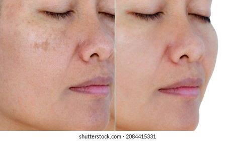 Image before and after spot melasma pigmentation facial treatment on middle age asian woman face. skincare and health problem concept. 