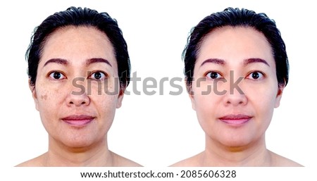 Image before and after spot melasma pigmentation facial treatment on middle age asian woman face isolated on white. Skincare and health problem concept. 