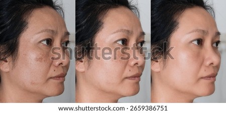Image before and after spot melasma pigmentation treatment development on skin face Asian woman compare in 3 levels of changes. Skincare and beauty concept
