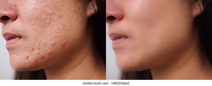 Image Before And After Spot Red Scar Acne Pimples Treatment On Face Asian Woman. Problem Skincare And Beauty Concept. 