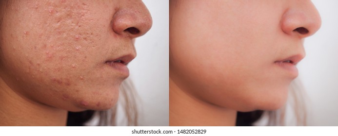 Image Before And After Spot Red Scar Acne Pimple Treatment On Young Face Asian Woman. Problem Skincare And Beauty Concept. 