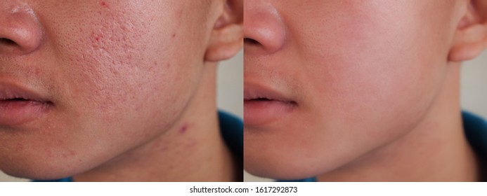 Image Before And After Spot Red Scar Acne Pimple Treatment On Face Asian Man. Problem Skincare And Health Concept. 