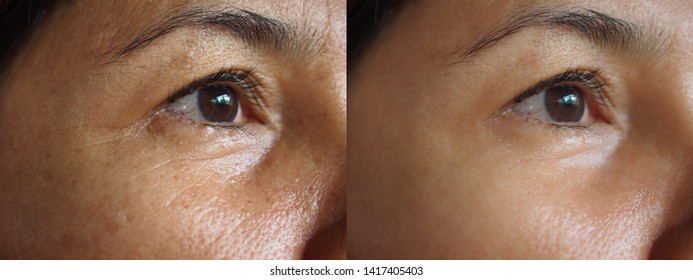 Image before and after treatment rejuvenation surgery on face asian woman concept .Closeup wrinkles dark spots pigmentation on senior female. 