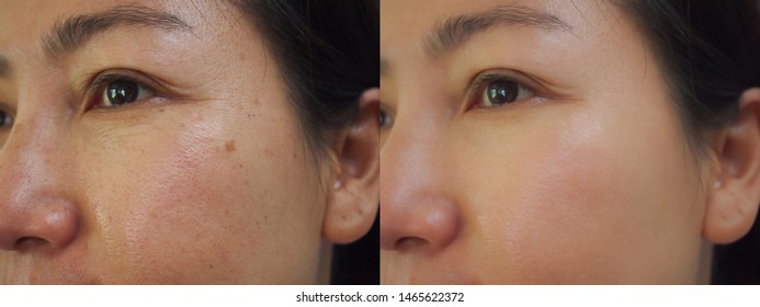 Image before and after treatment rejuvenation surgery on face asian woman concept. Closeup wrinkles dark spots pigmentation skin on face asian woman. 