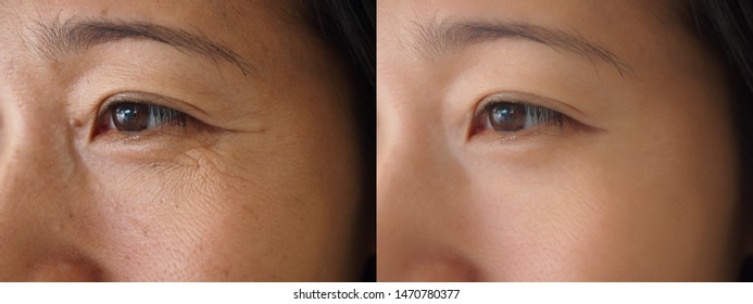 Изображение до и после лечения омоложения на лице азиатской женщины концепции. Крупный план морщин, темных пятен, пигментации на лице женщины. 