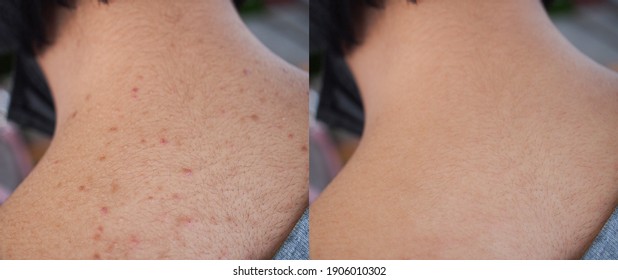 Image Before And After Treatment Spot Acne Pimples On Skin Back Of Teenage Women. 