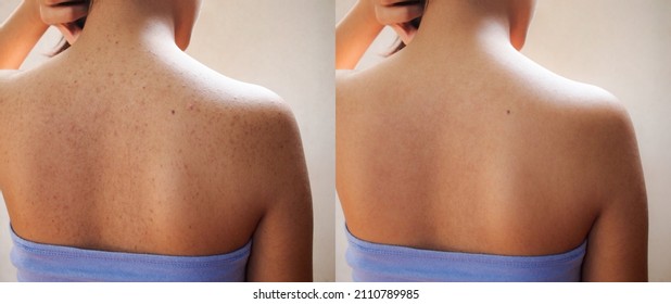 Image before and after treatment spot scar acne pimples on skin back of teenage women. 