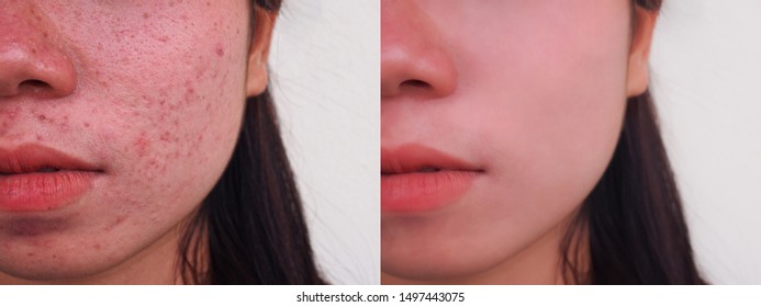 Image Before And Spot Red Scar Acne Pimple Treatment On The Face Of Young Asian Woman With Copy Space. Problem Skincare And Beauty Concept. 