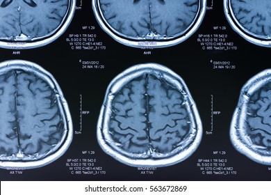 Image Of Brain Scan Patient By Ct Scan.