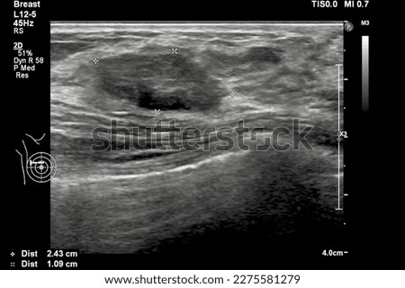 Image of breast ultrasound for cancer checks in women with breast mass.A female with a breast lump was done ultrasonography for breast cancer or tumor screening in the hospital.