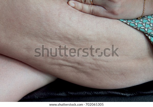 Image Cellulite On Woman Thighcellulite Orangepeel Stock Photo