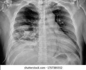 Image Of Chest Tube Drainage At Right Side. PCD(percutaneous Catheter Drainage) Was Used In Patients To Diagnose And/or Treat Pleural Effusions,hemothorax,symptomatic Malignant Effusions And Empyemas.
