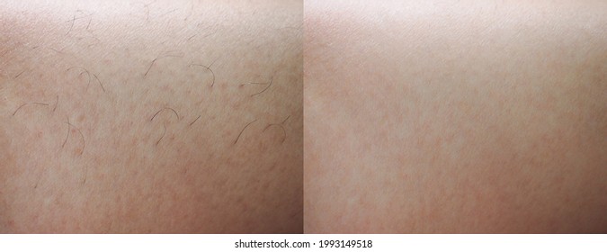 Image Closeup Before And After Hair Removal On Legs Of Woman. 