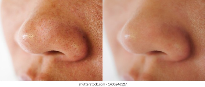 Image closeup before and after treatment small pimple acne blackheads on skin of nose and spot melasma pigmentation on facial Asian woman. Problem skincare and health concept. 